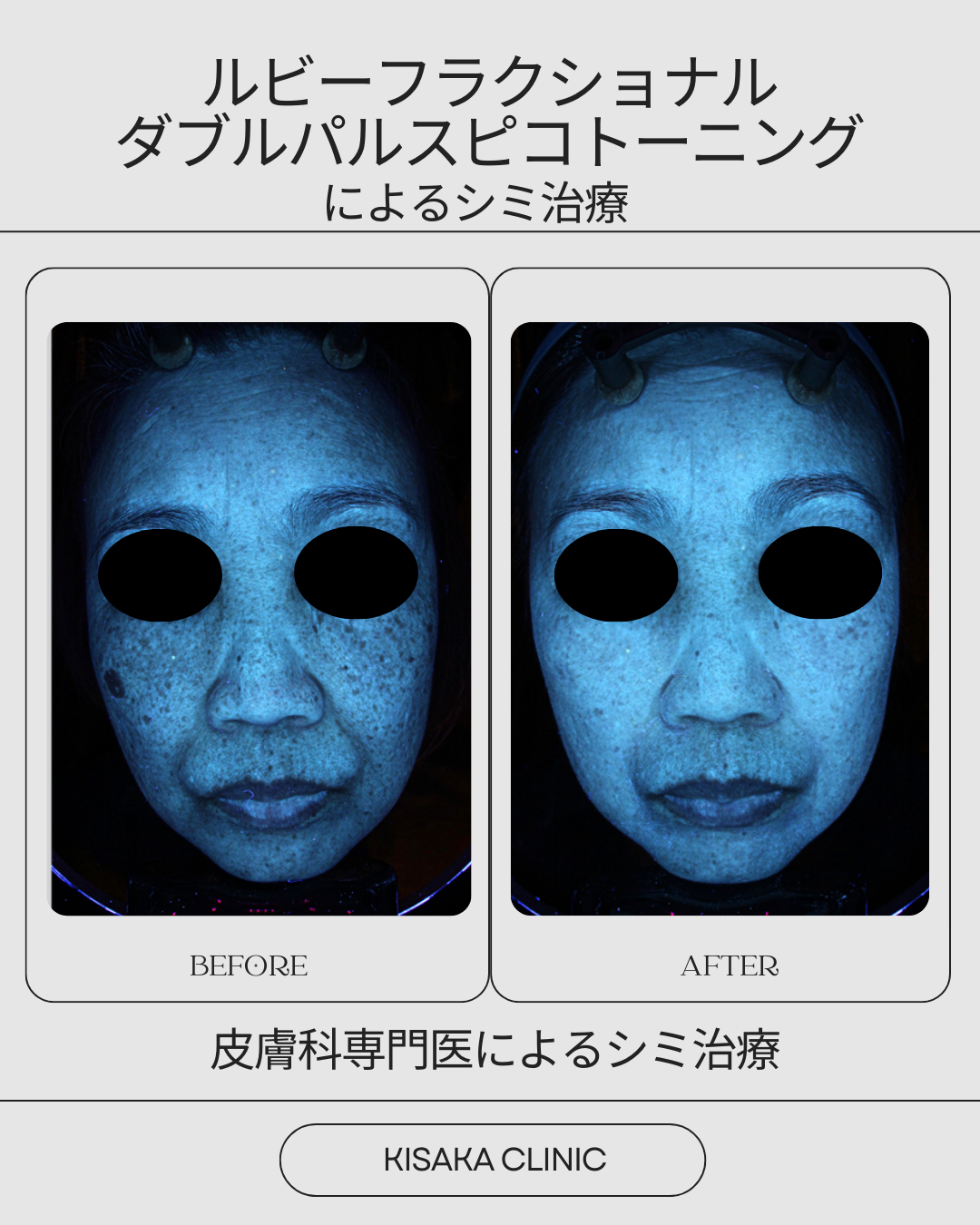 皮膚科専門医によるカスタマイズシミ治療