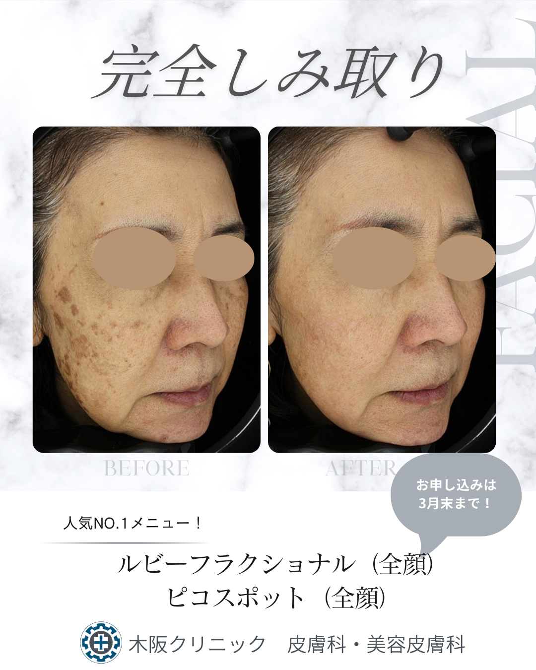 🎓🌸 卒業式・入学式を控えたお母さまへ 🌸🎓完全シミ取りプラン