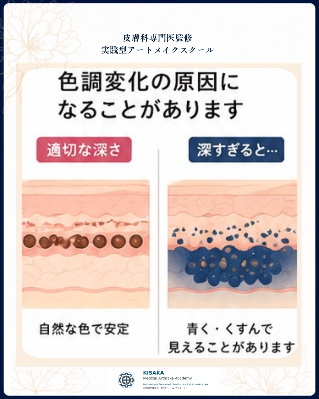 🩺 アートメイク「深く入れれば長持ちする」…本当にそうでしょうか？１