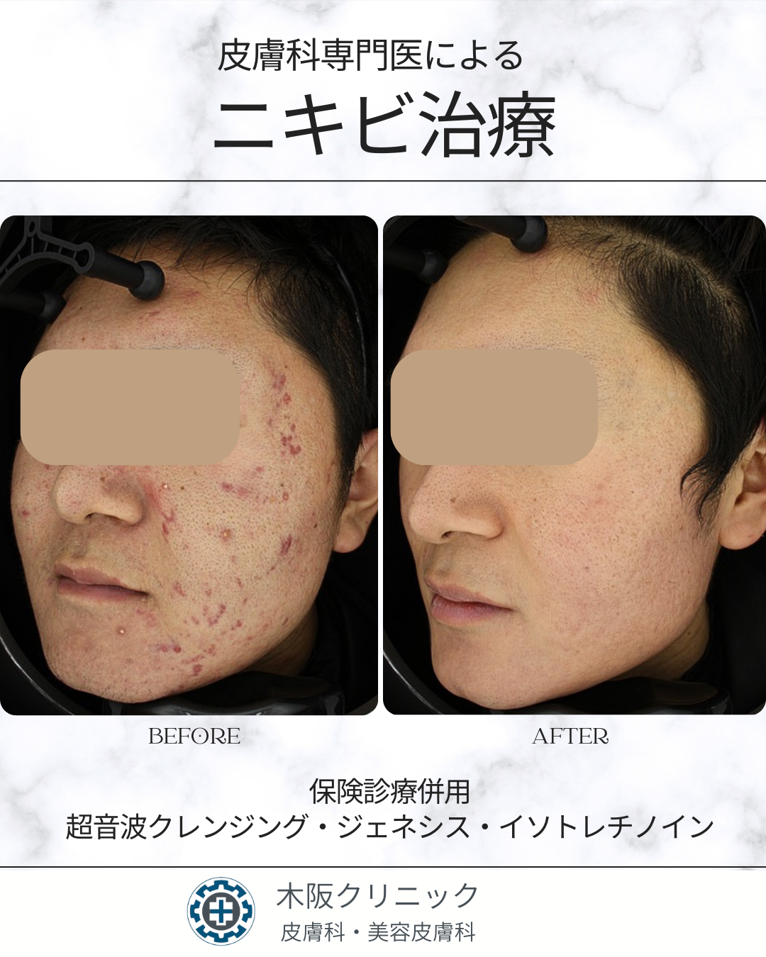 皮膚科専門医によるニキビ治療