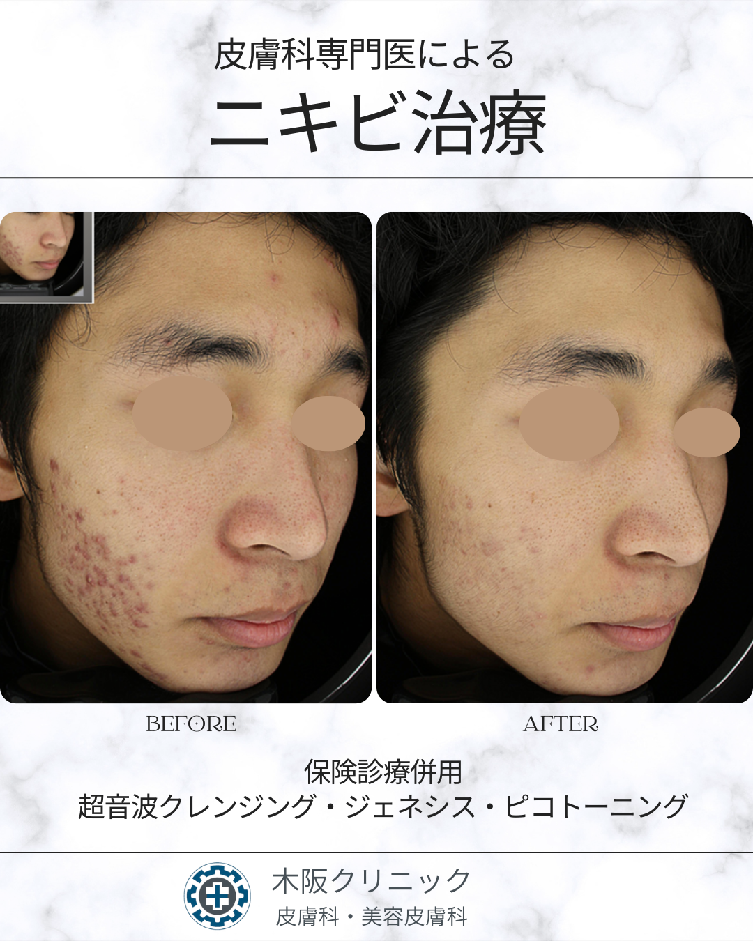 皮膚科専門医によるニキビ治療