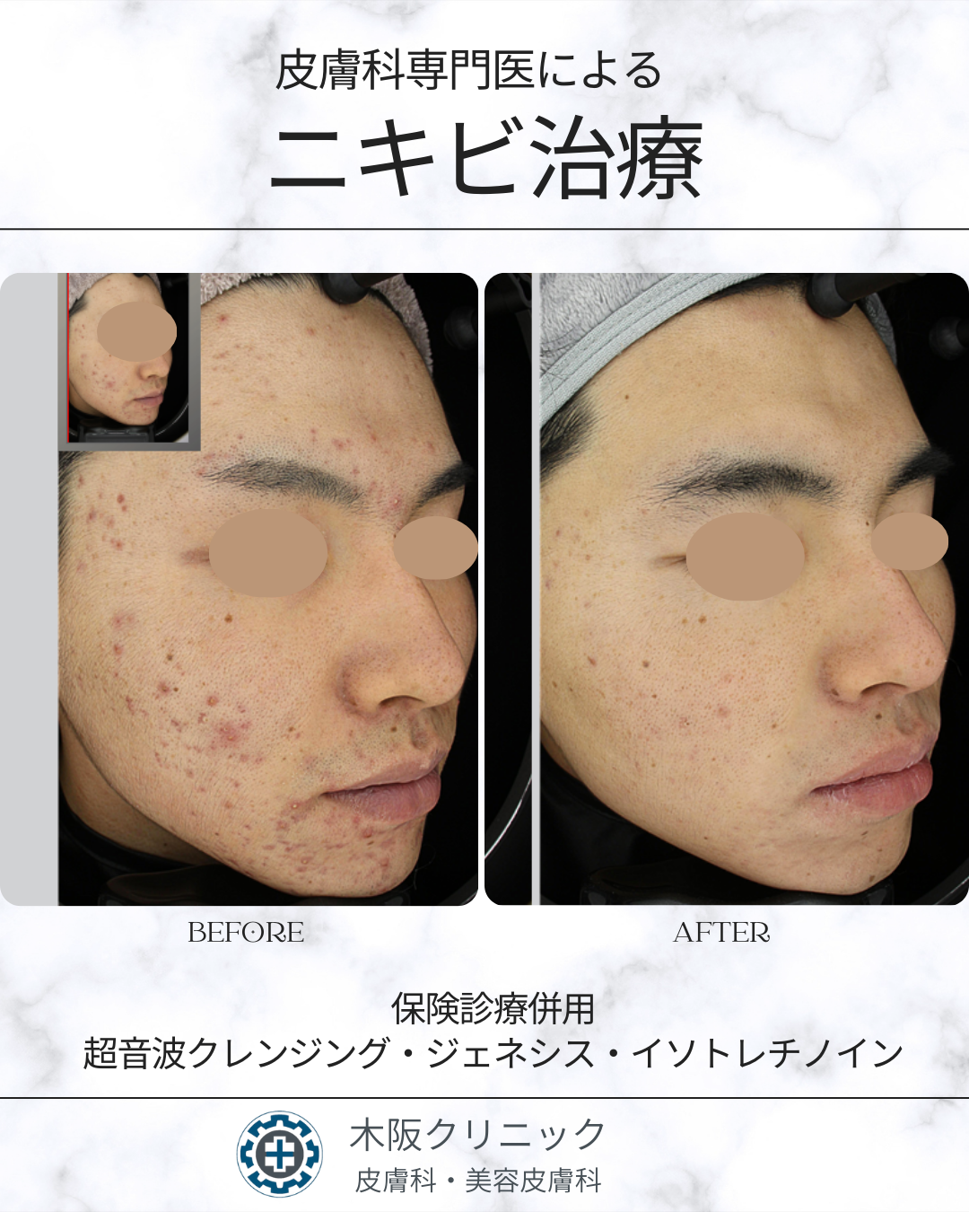 皮膚科専門医によるニキビ治療