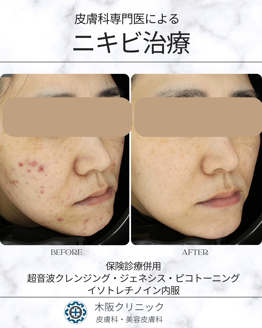 皮膚科専門医によるニキビ治療