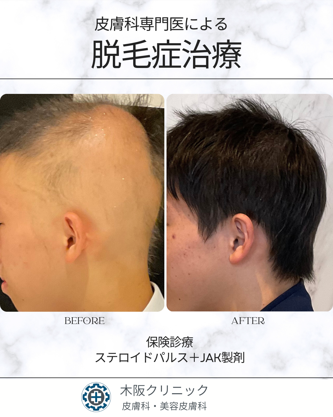 皮膚科専門医による脱毛症治療