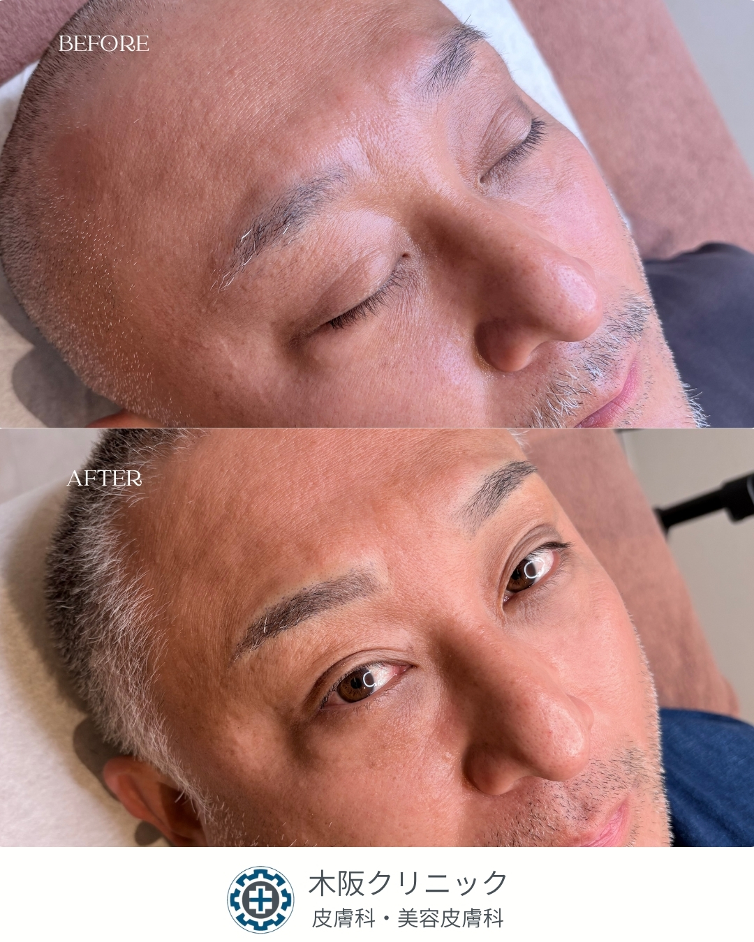 白髪　男性　アートメイク症例